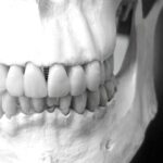 implantes dentales precio