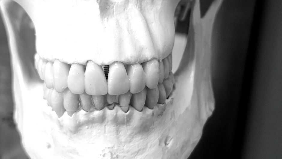 implantes dentales precio
